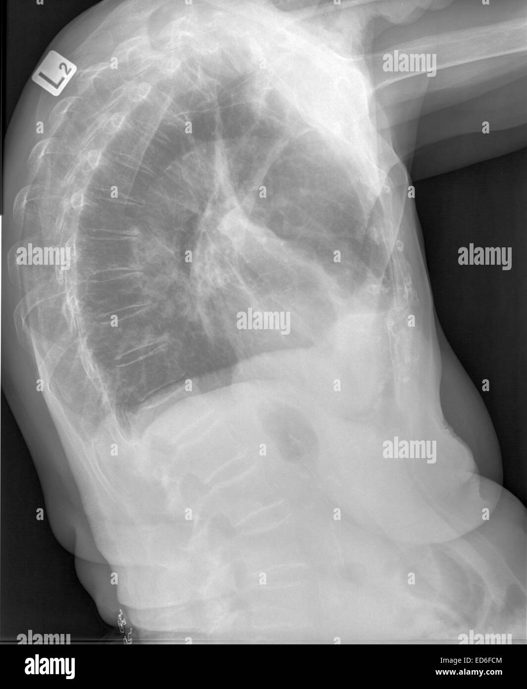 Chest x-rays during lungs Tuberculosis also called as MTB or TB of