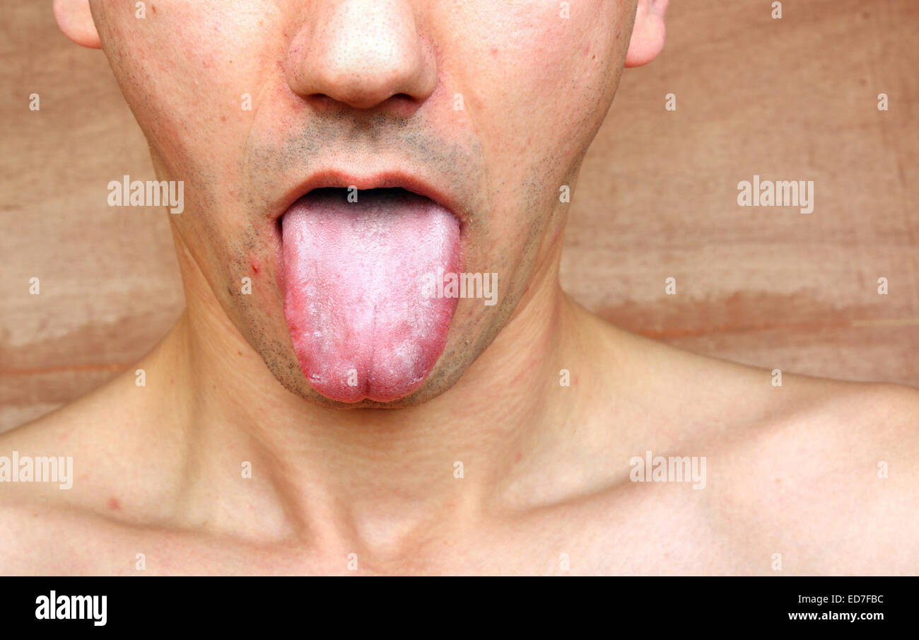 Anemia tongue hires stock photography and images Alamy