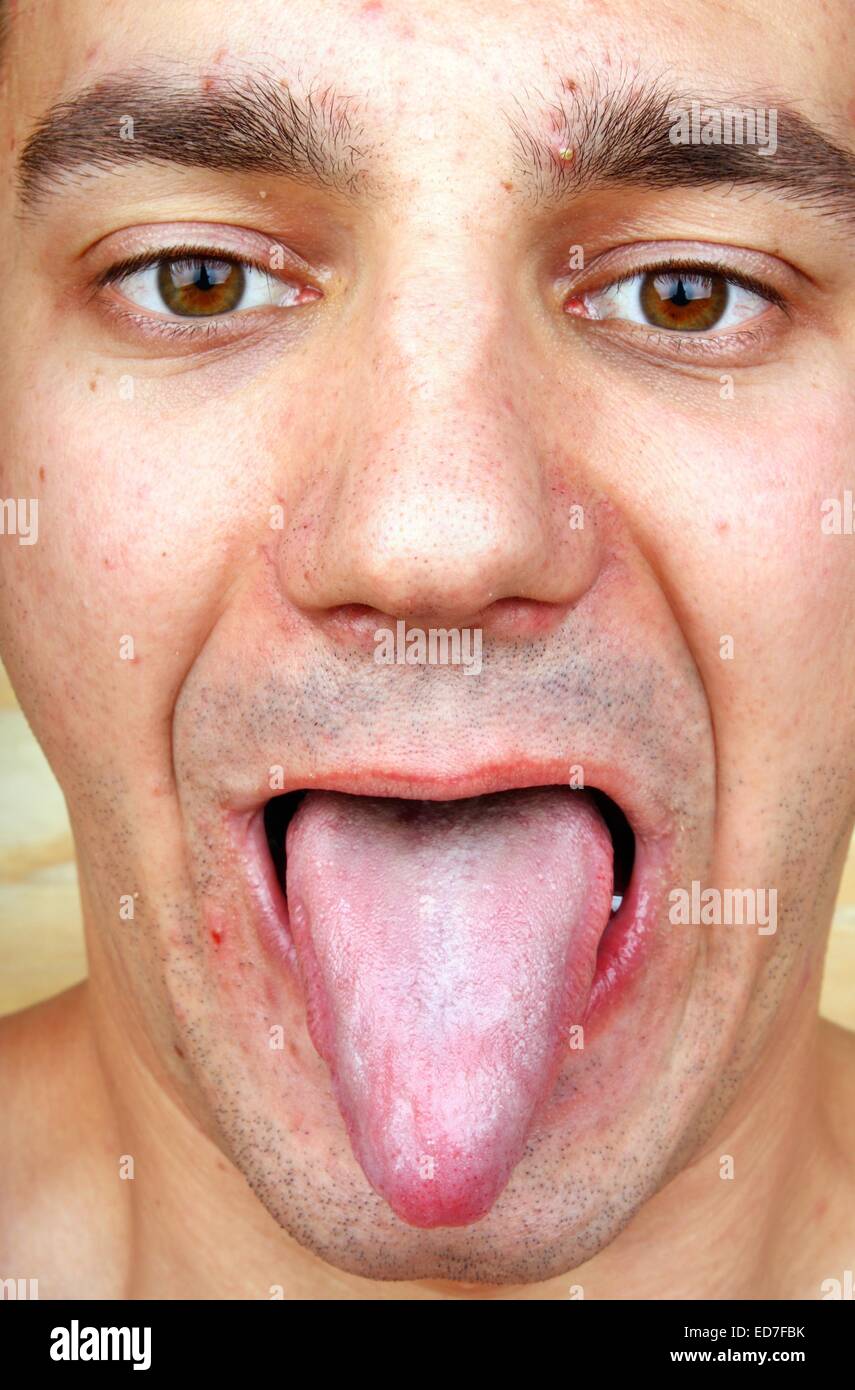 Terrified young boy because of herpes acne on the face Stock Photo Alamy
