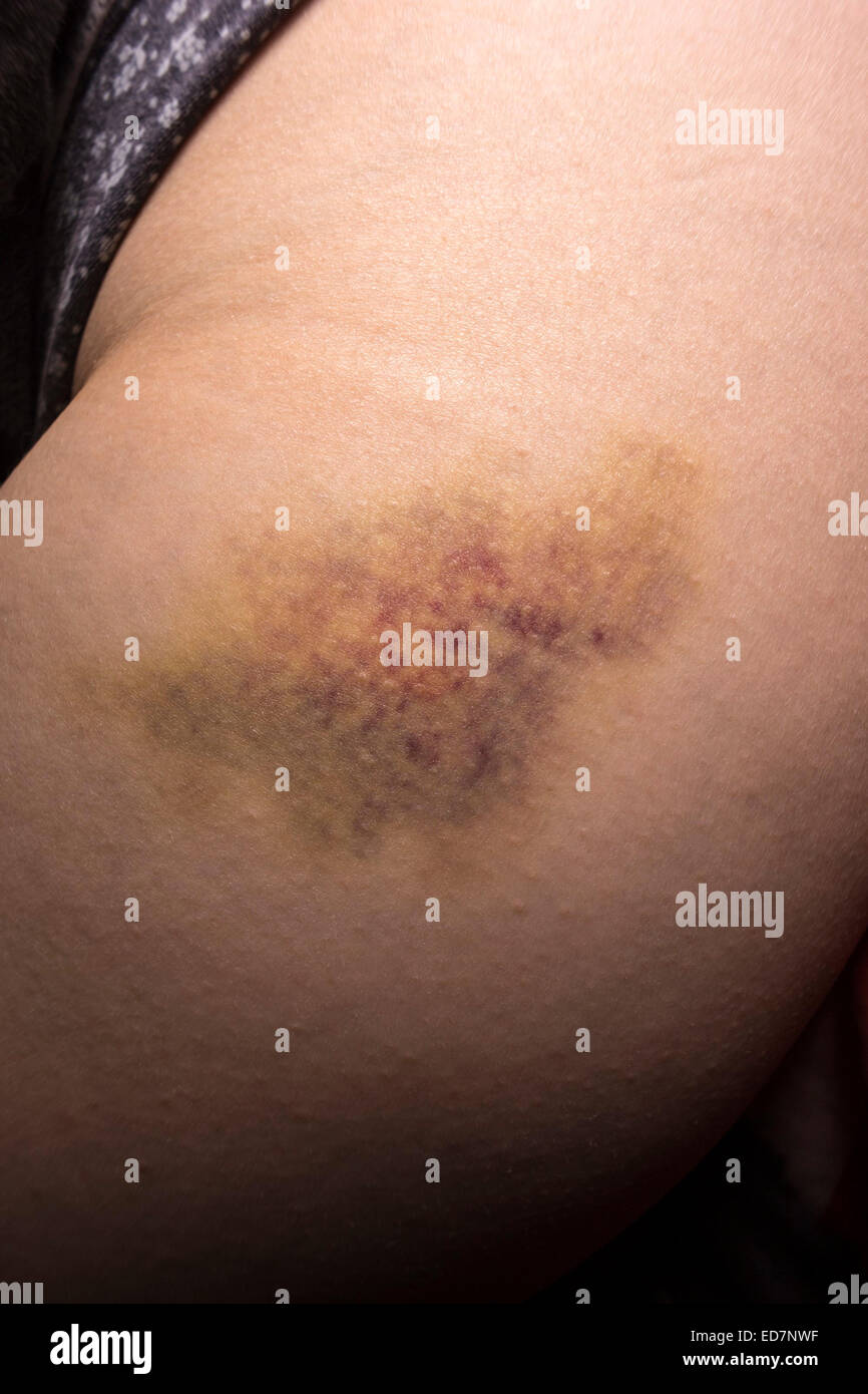 Closeup on a Bruise on wounded woman leg. Stock Photo