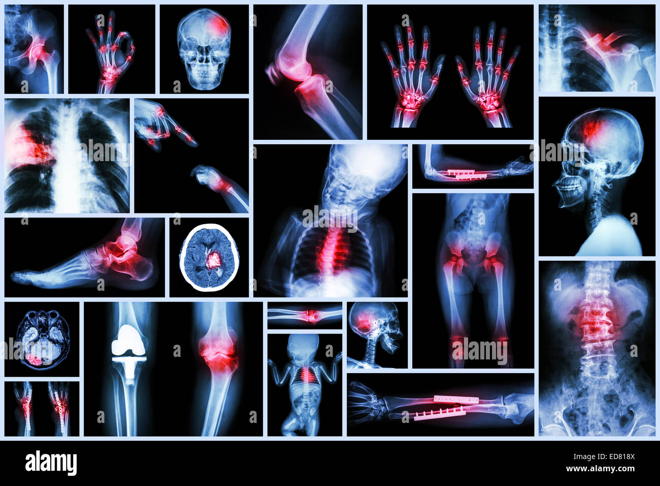 Collection X-ray multiple human's organ & orthopedic surgery & Multiple disease (Pulmonary tuberculosis , Gout , Rheumatoid arth Stock Photo