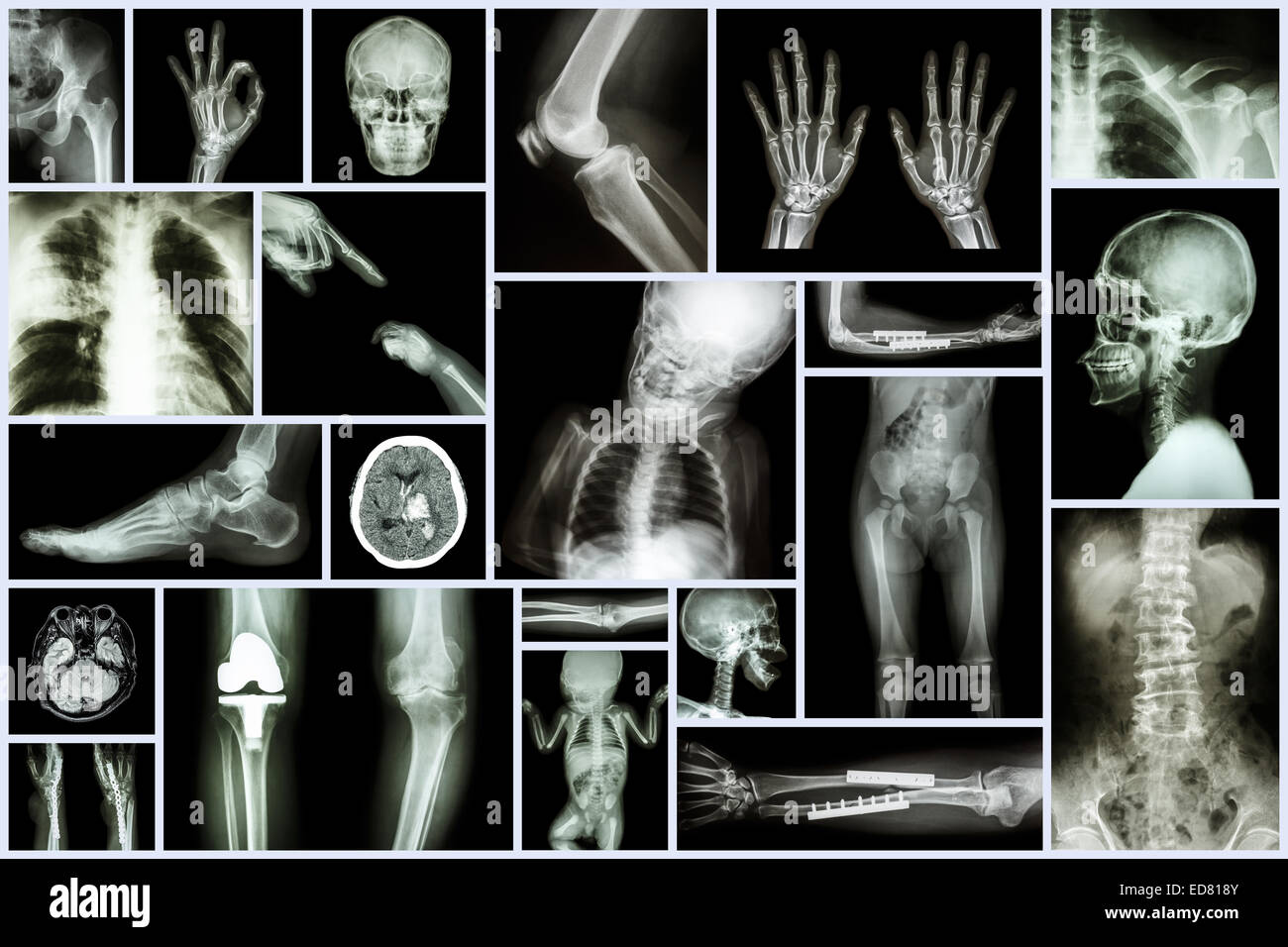 Collection X-ray multiple part of human & Orthopedic surgery & Multiple disease (Osteoarthritis knee,spondylosis,Stroke,Fracture Stock Photo