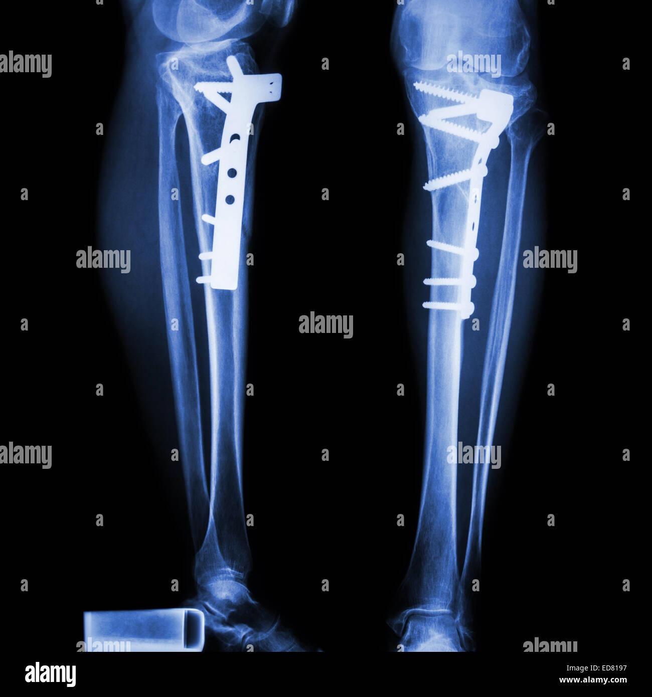 fracture tibia(leg bone). It was operated and internal fixed by plate&screw Stock Photo