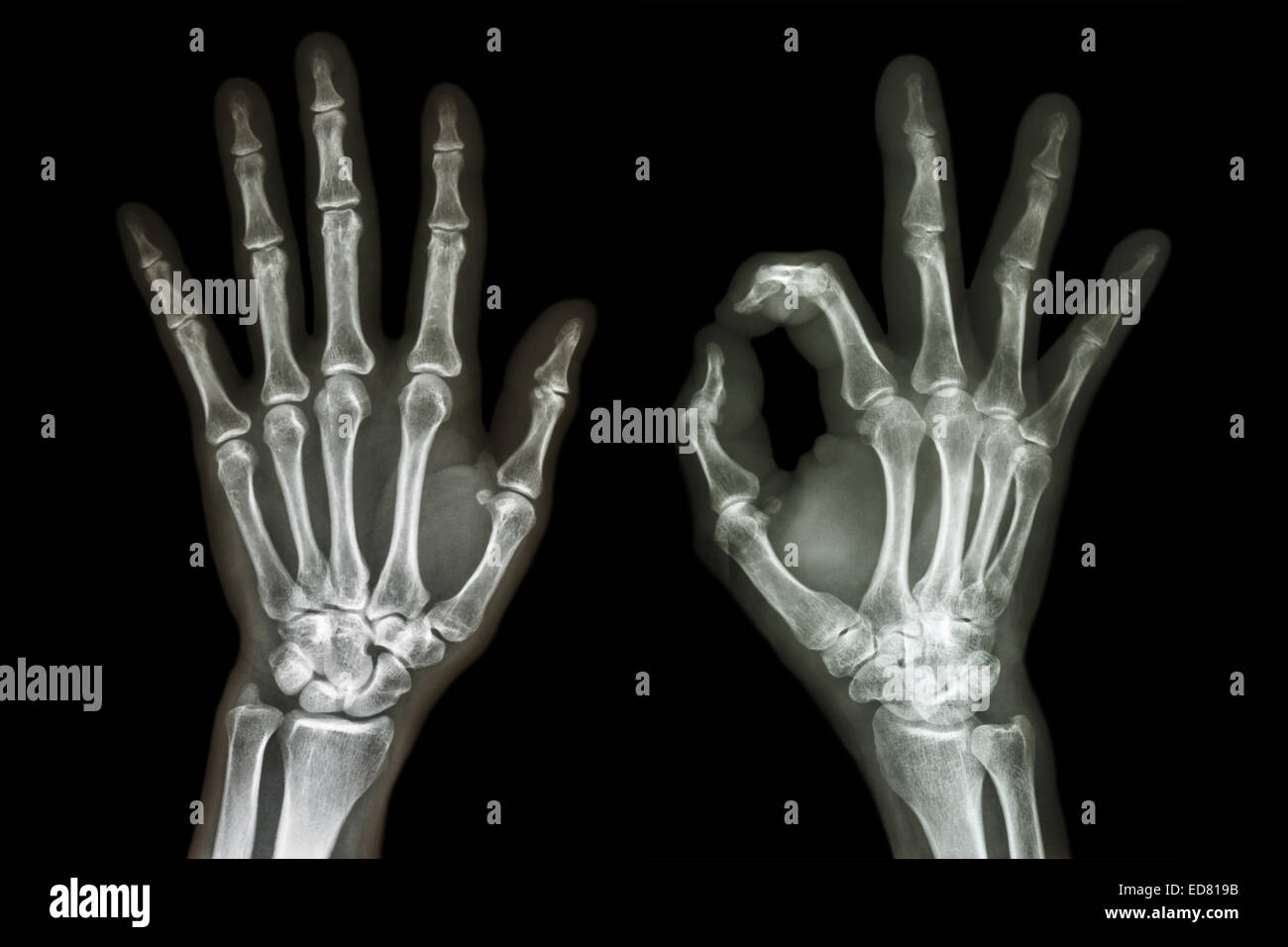 X-ray both hands with OK sign Stock Photo