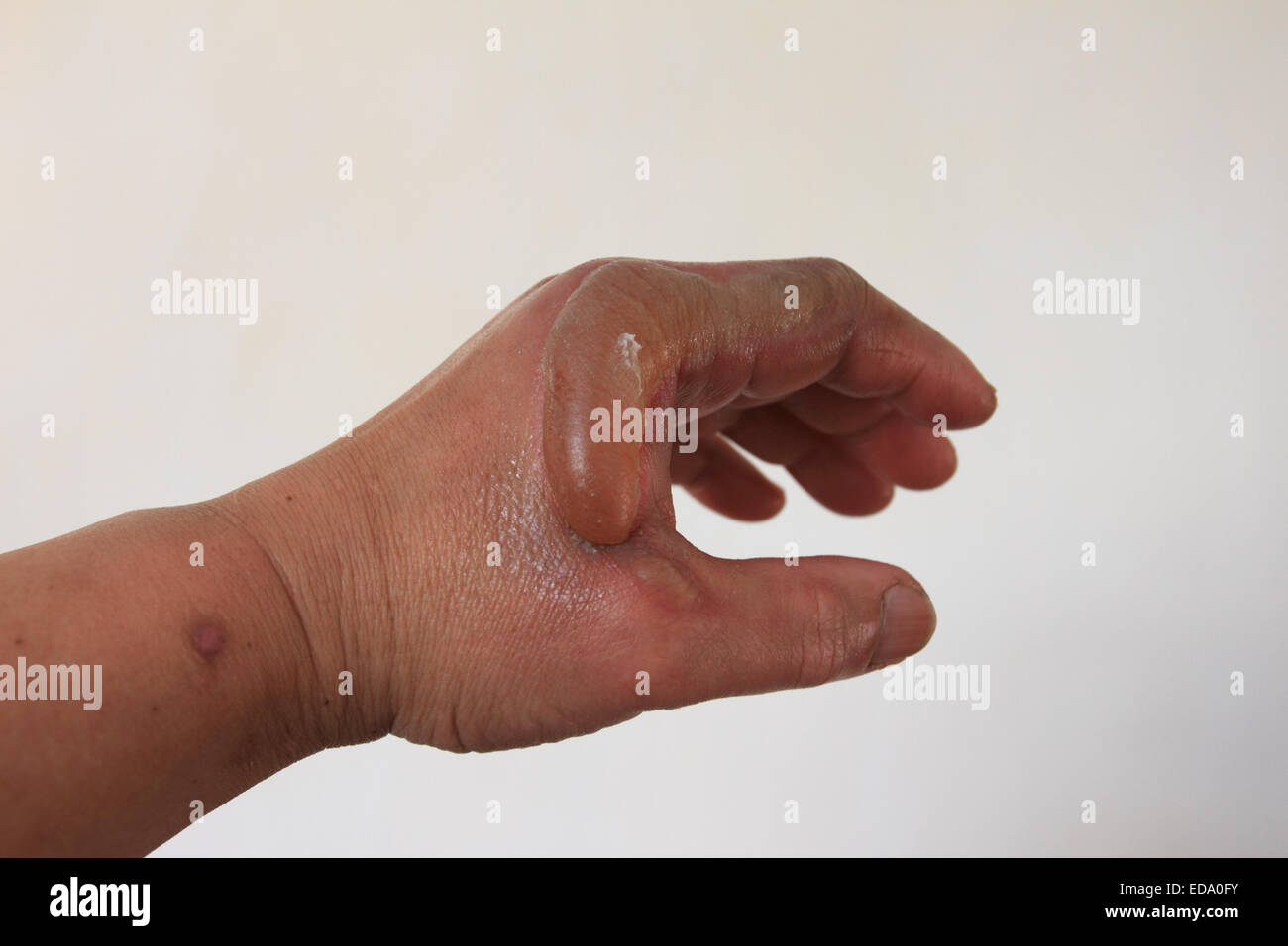Blister, male left hand has accident, second degree burn, healing wound on left hand, Norfolk, UK Stock Photo