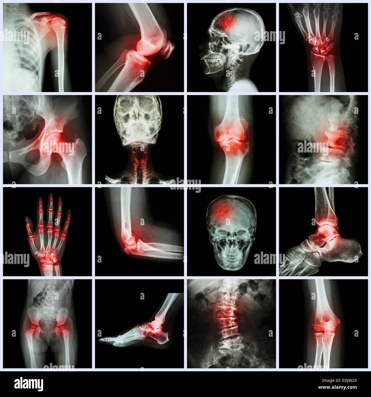 Collection human joint and arthritis and stroke ( skull head neck shoulder chest thorax shoulder arm elbow forearm wrist hand fi Stock Photo