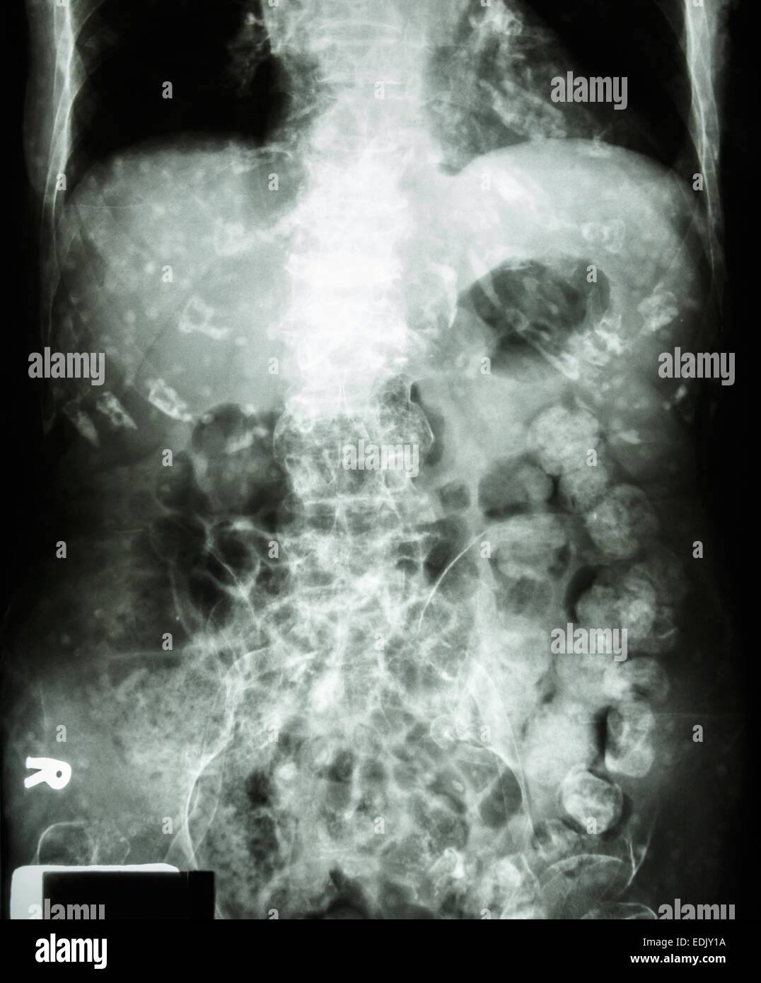 ' Constipation '   ( X-ray abdomen of old man : a lot of feces in large bowel and calcified at rib ) Stock Photo