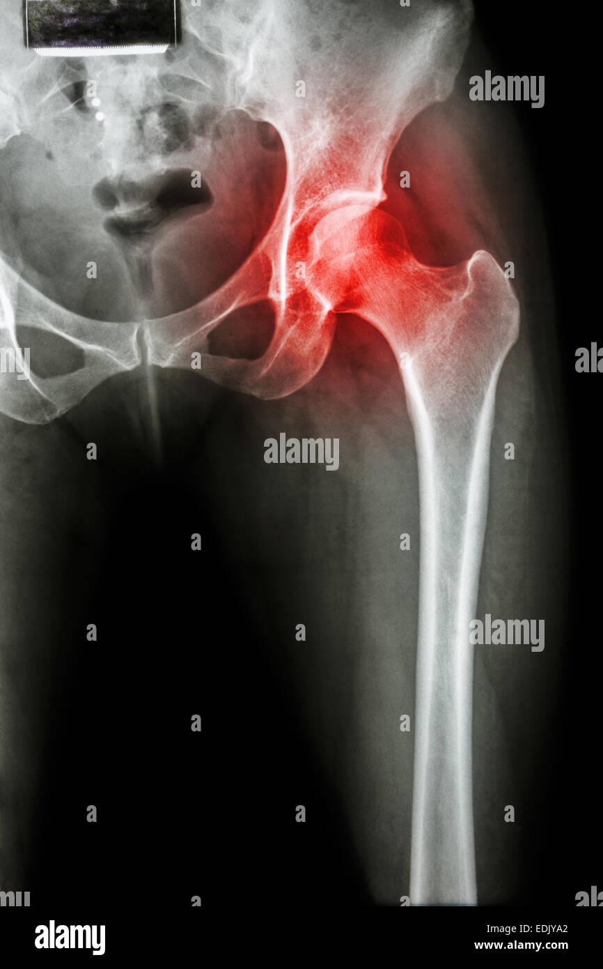 Arthritis at hip joint ( Xray pelvis & hip joint ) , ( Gout , Rheumatoid Stock Photo Alamy