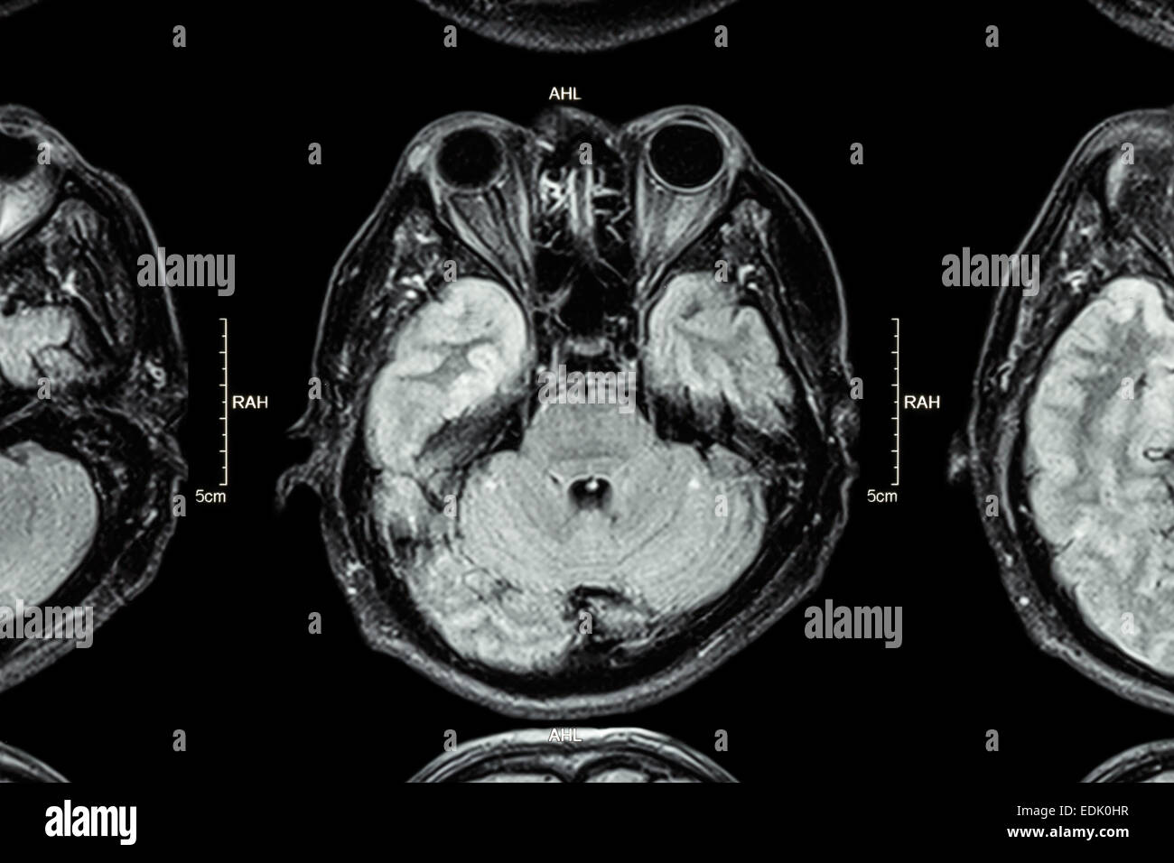 Close up of MRI brain : Lower part of brain ( eyes , temporal lobe of cerebrum , cerebellum , brain stem ) Stock Photo