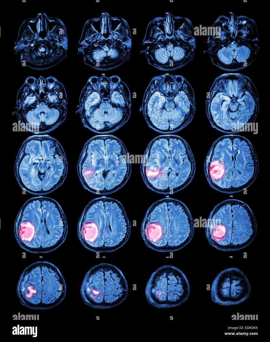 Mri brain tumor hires stock photography and images Alamy
