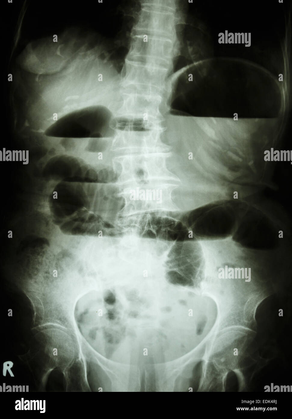Film X-ray abdomen upright show small bowel dilated and air-fluid level in small bowel due to small bowel obstruction Stock Photo
