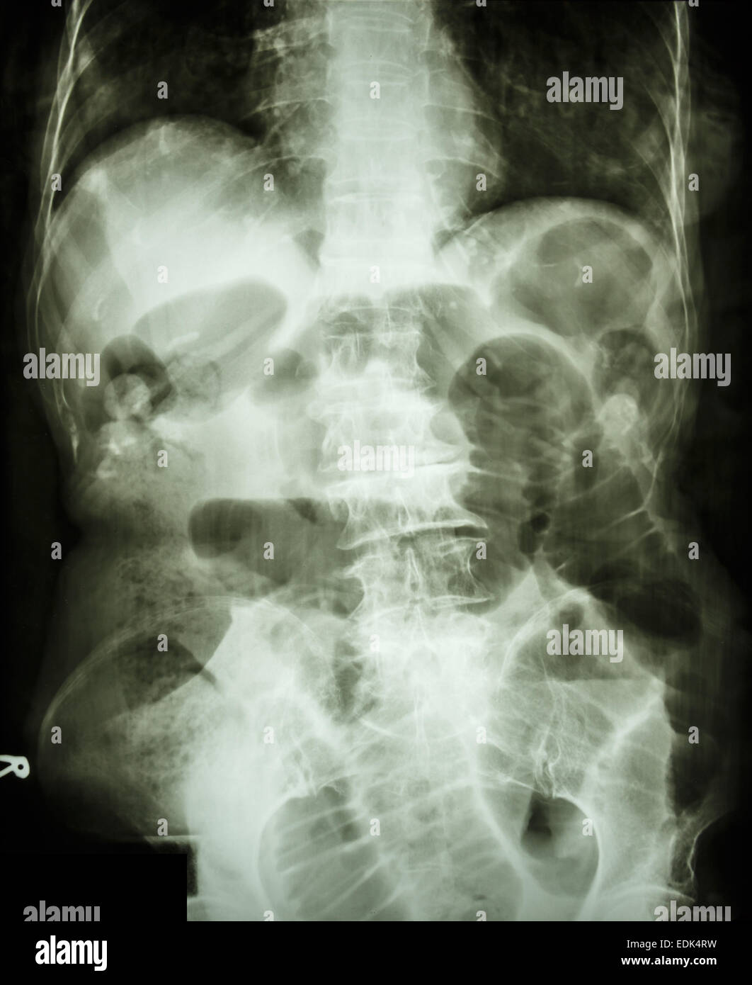Film Xray abdomen supine show small bowel dilated and air in small