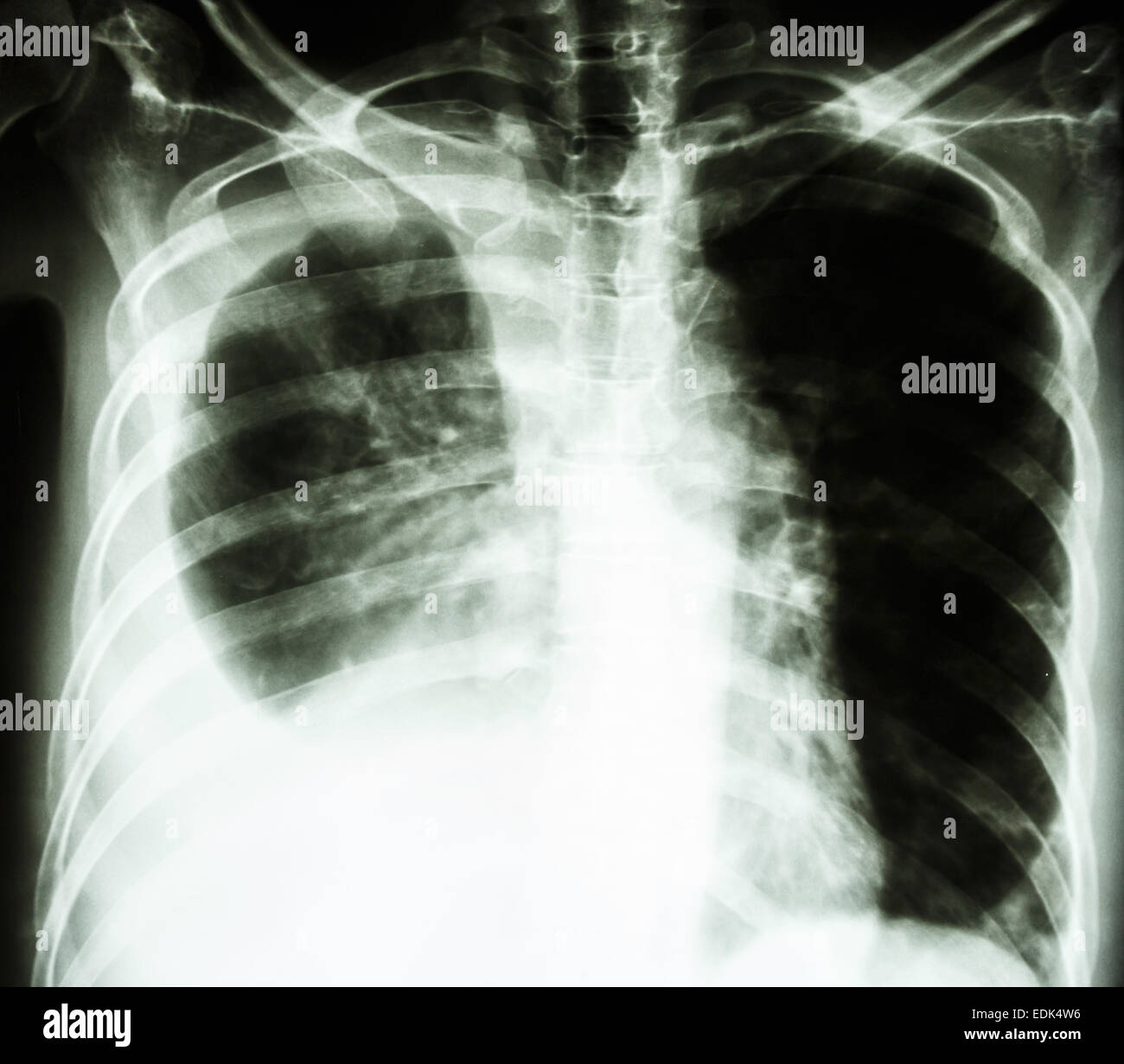 film chest X-ray PA upright : show pleural effusion at right lung due to lung cancer Stock Photo