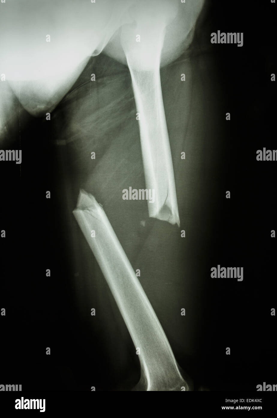 Film X-ray Left femur(left thigh) show complete fracture shaft of femur and displace Stock Photo