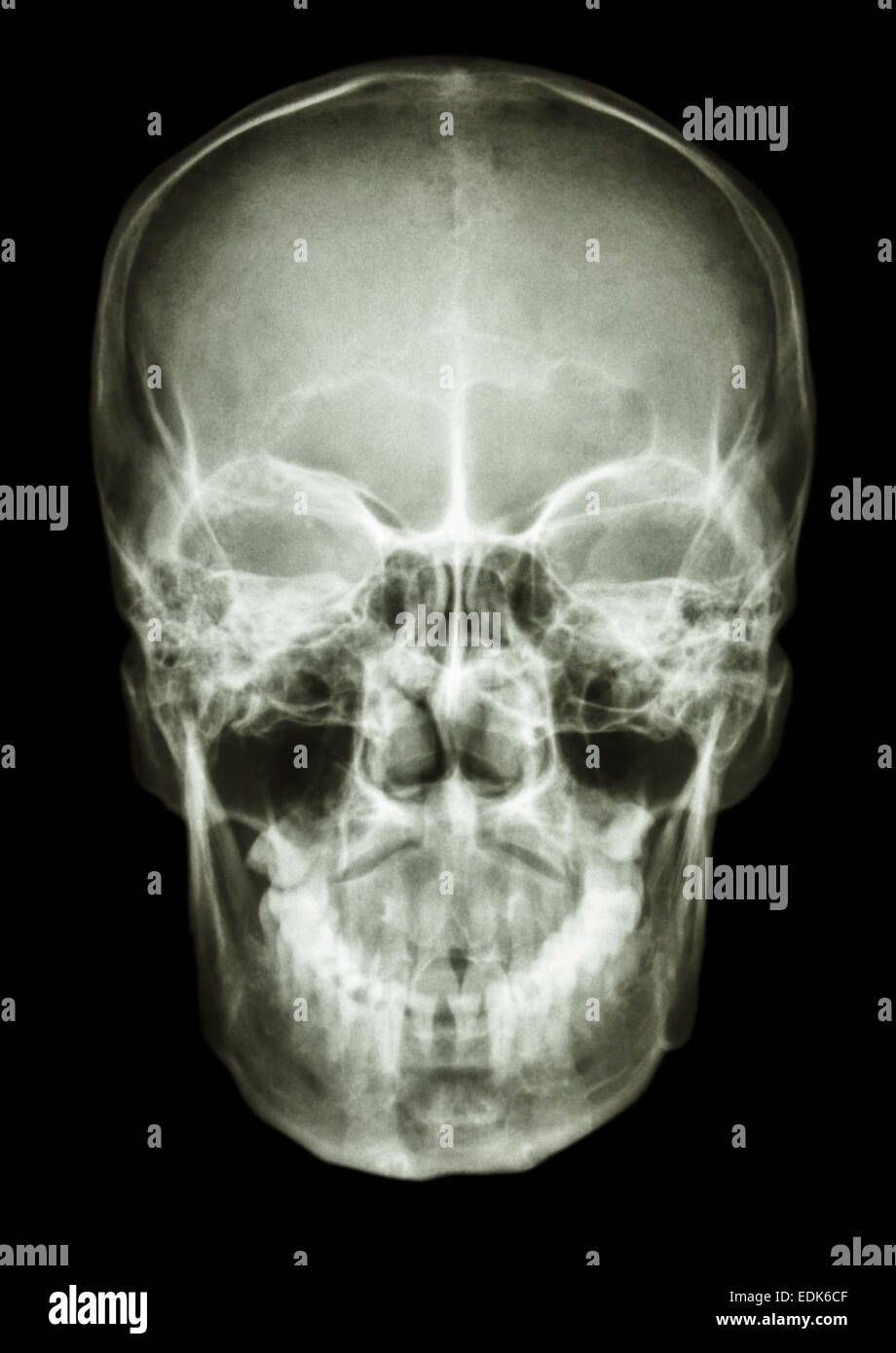film x-ray skull AP : show normal human's skull Stock Photo