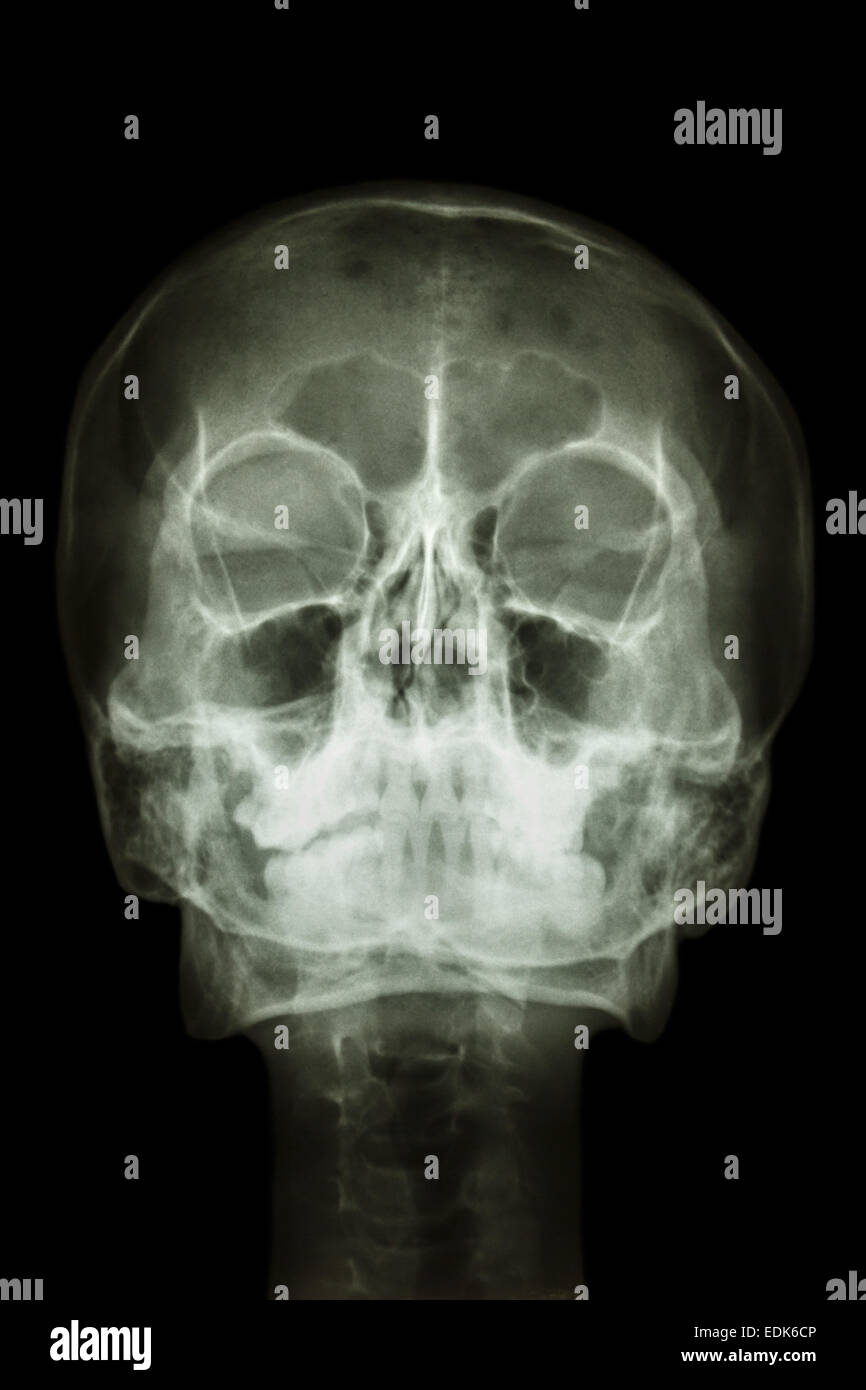 film x-ray skull : show normal human's skull and cervical spine Stock Photo