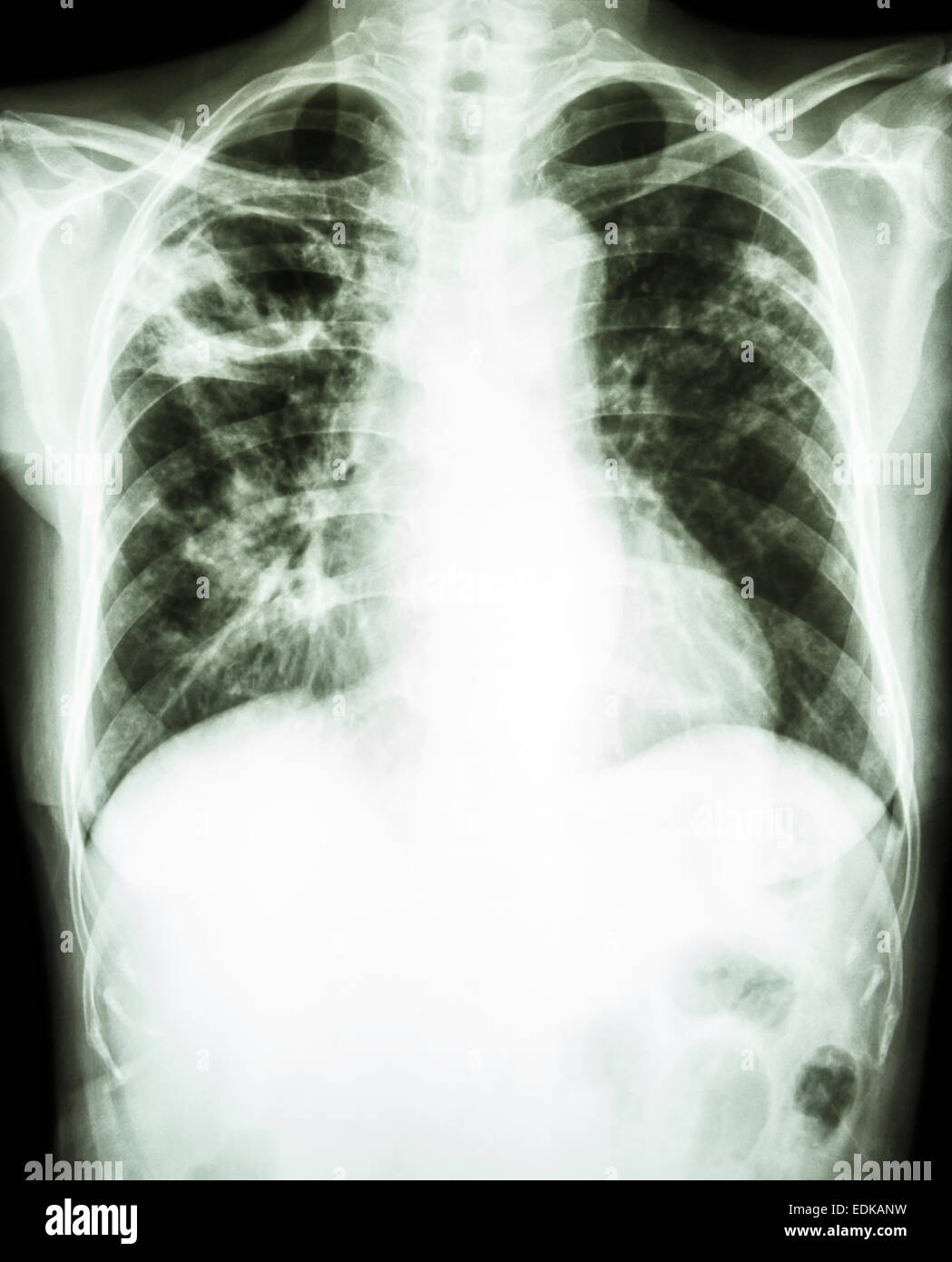 Pulmonary Tuberculosis Chest X Ray