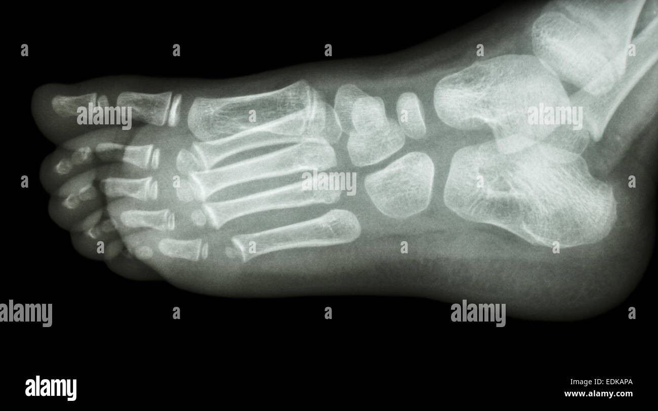 film xray foot lateral show normal child's foot Stock