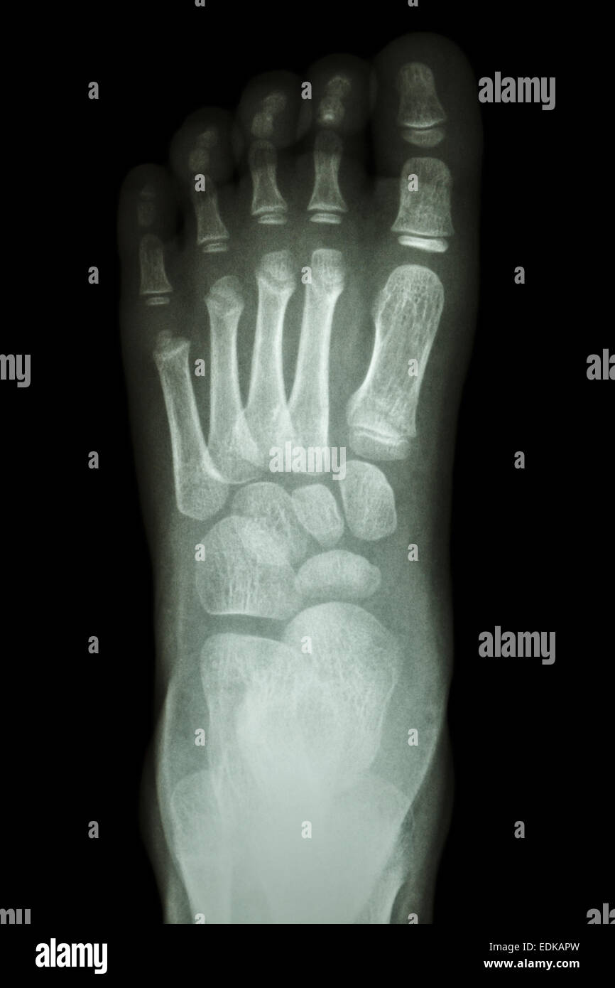 film x-ray foot AP : show normal child's foot Stock Photo