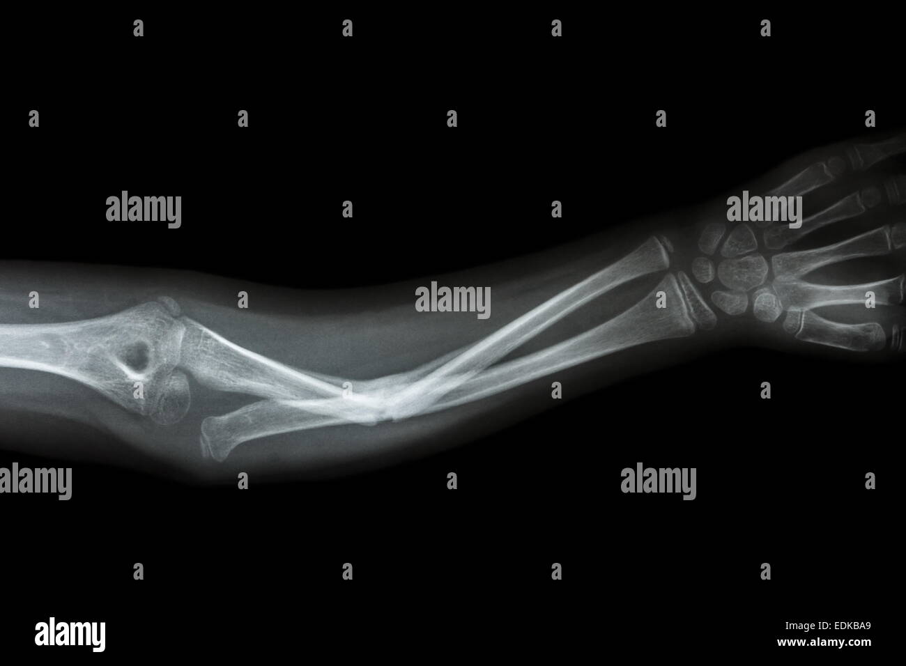 film x-ray forearm AP : show fracture shaft of ulnar(forearm's bone) Stock Photo