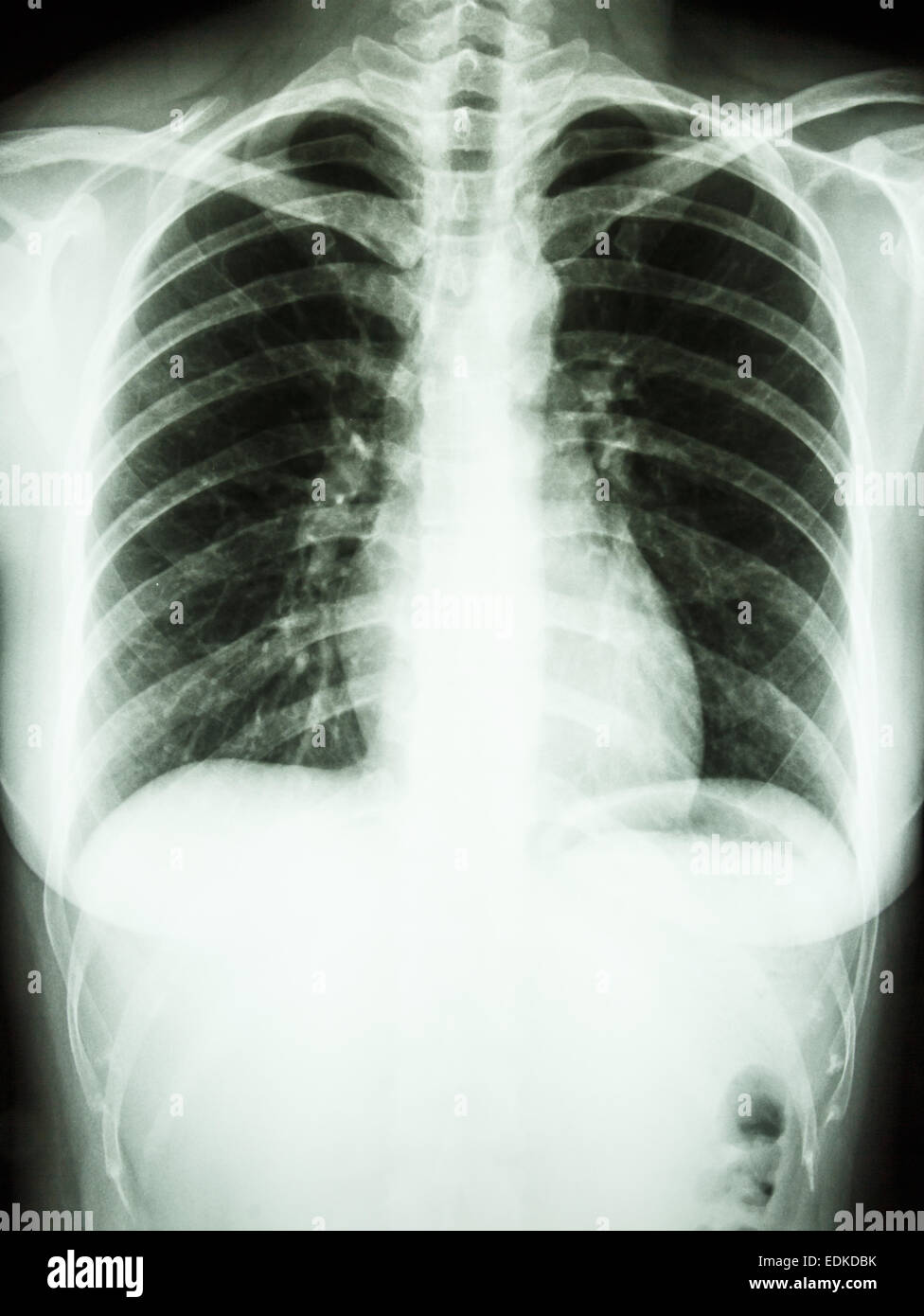Film chest Xray PA upright show normal human' chest Stock