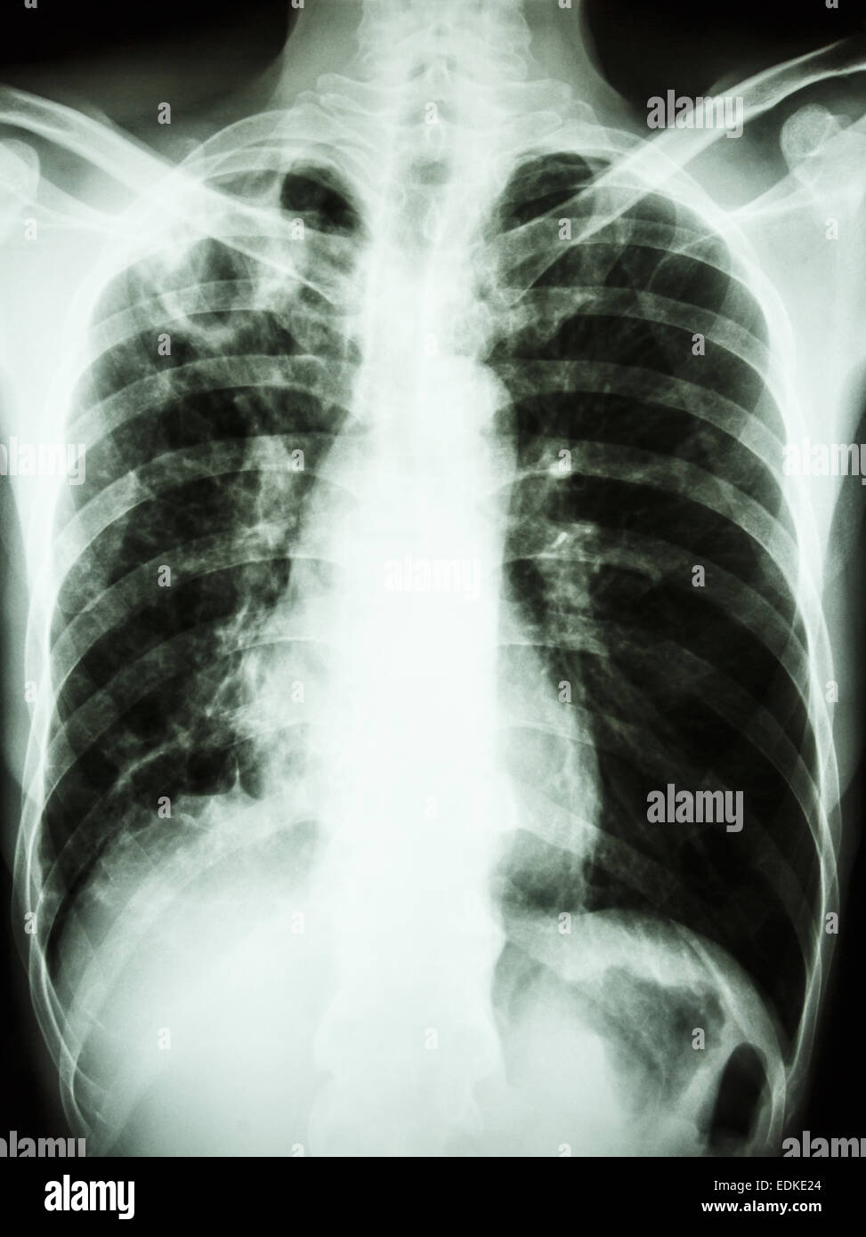 film chest x-ray show cavity at right upper lung due to Mycobacterium tuberculosis infection (Pulmonary Tuberculosis) Stock Photo