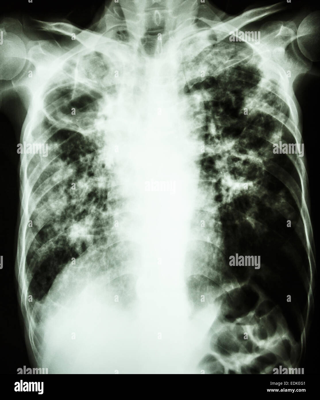 film chest xray show cavity at right lung,fibrosis & interstitial