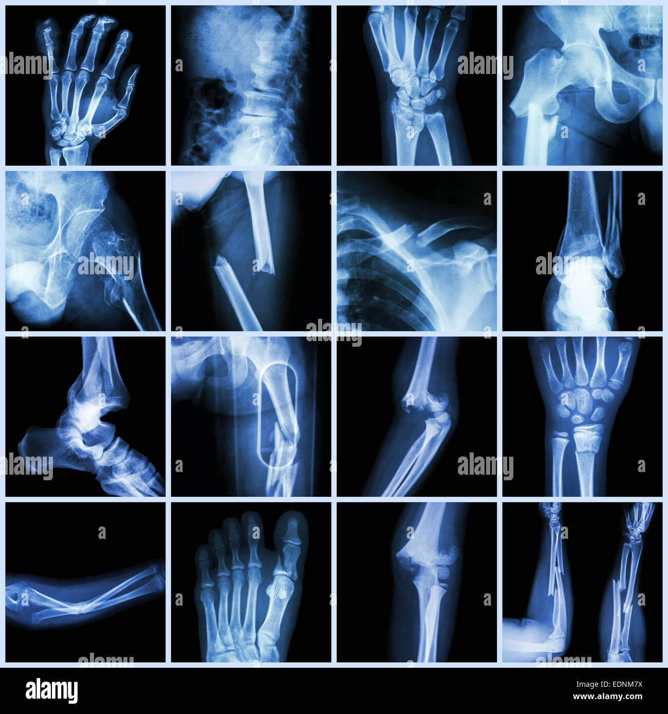 Collection Xray multiple bone fracture (finger,spine,wrist,hip,leg