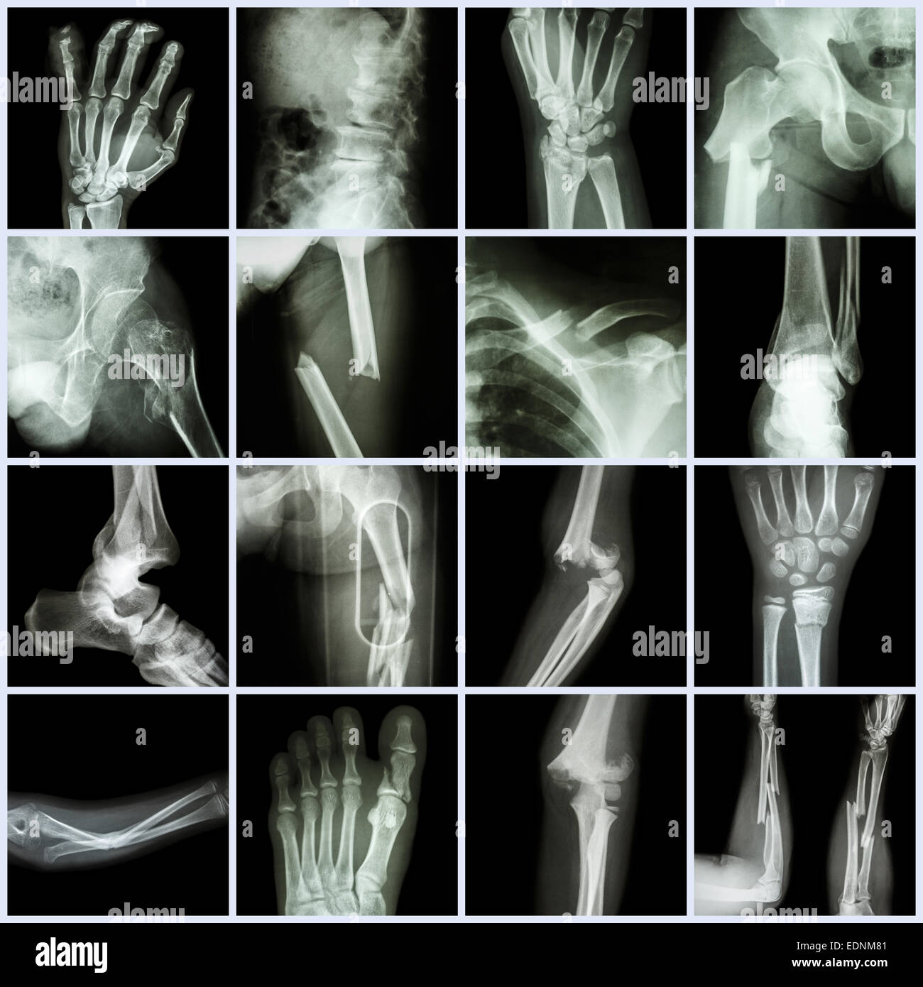 Collection X-ray multiple bone fracture (finger,spine,wrist,hip,leg,clavicle,ankle,elbow,arm,foot) Stock Photo