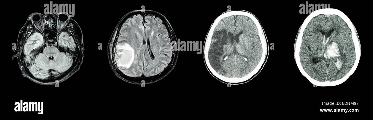 Collection CT scan of brain and multiple disease (Left to Right  :  Normal brain,Brain tumor,Cerebral infarction,Intracerebral h Stock Photo