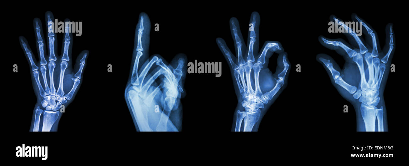 Collection X-ray symbol hands Stock Photo