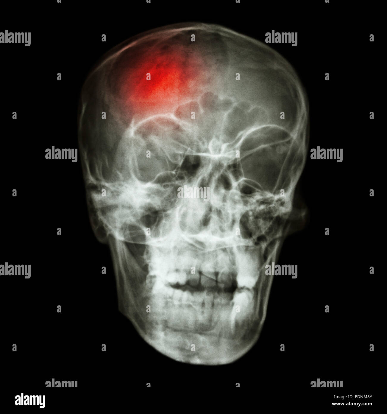 Broken Skull X Ray
