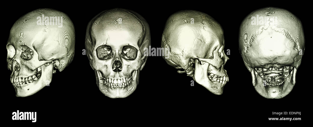 CT scan of human skull and 3D Stock Photo