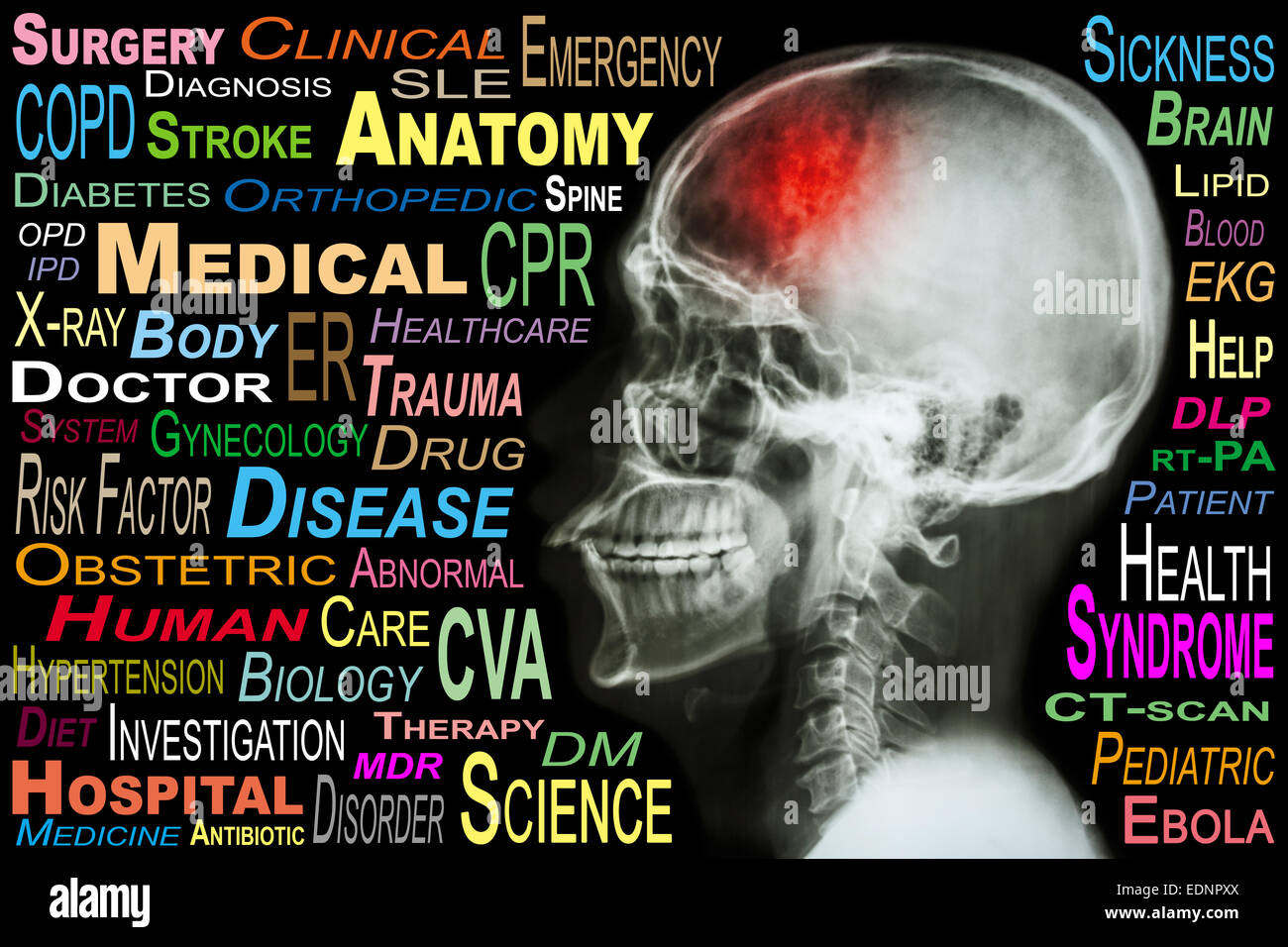 X-ray skull and 'Stroke' and Medical word cloud Stock Photo