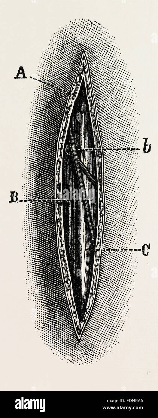 ligature, medical equipment, surgical instrument, history of medicine Stock Photo Alamy