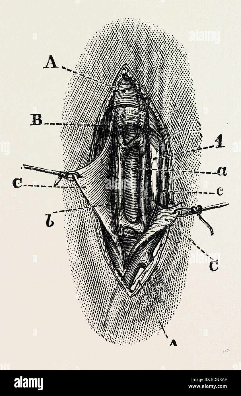 ligature, medical equipment, surgical instrument, history of medicine