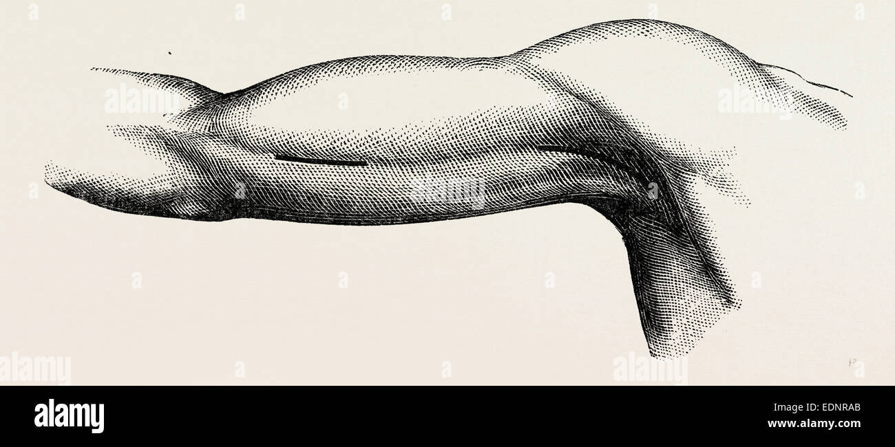 ligature of the brachial about the middle of the arm, medical equipment, surgical instrument