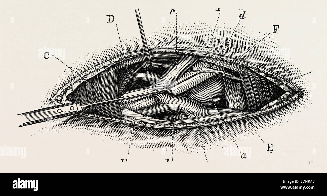 ligature of the right subclavian ernird part, medical equipment
