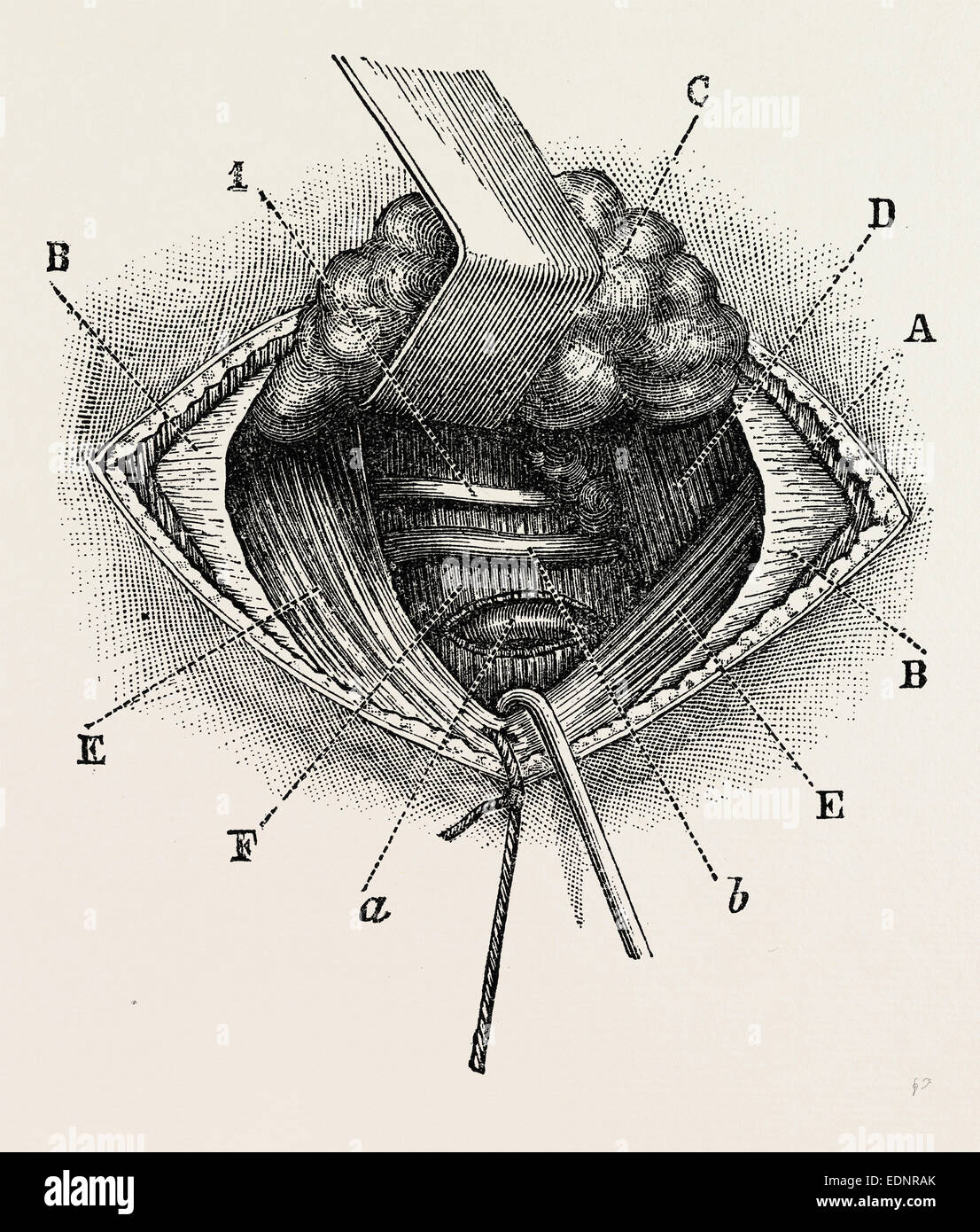 ligature of right lingual artery, medical equipment, surgical