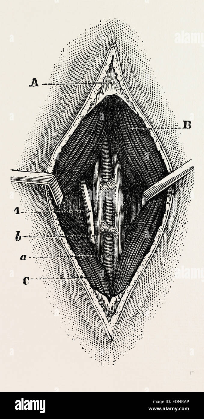 tractor, the outer border of the ligature, medical equipment, surgical