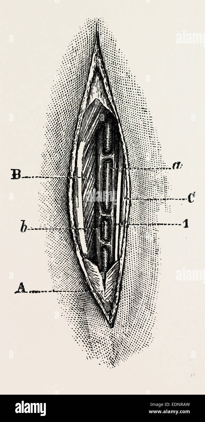 ligature, medical equipment, surgical instrument, history of medicine