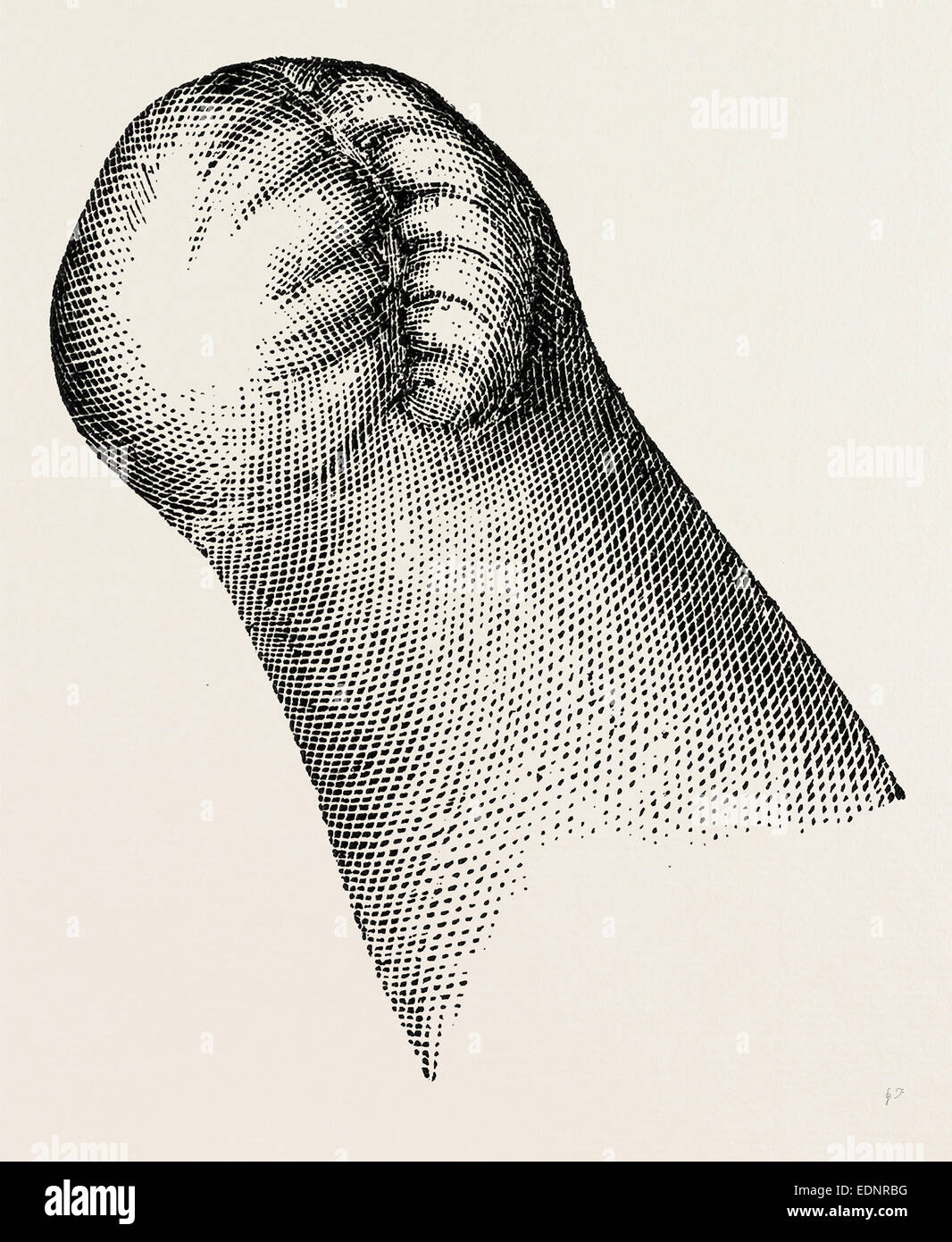 stump of right, medical equipment, surgical instrument, history of medicine Stock Photo Alamy