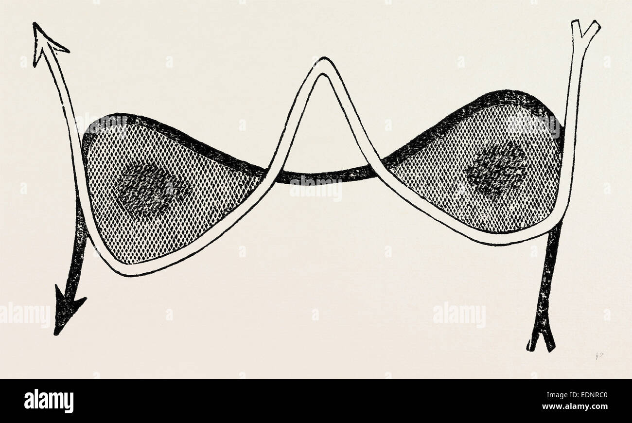 The 66 incision, medical equipment, surgical instrument, history of medicine Stock Photo Alamy