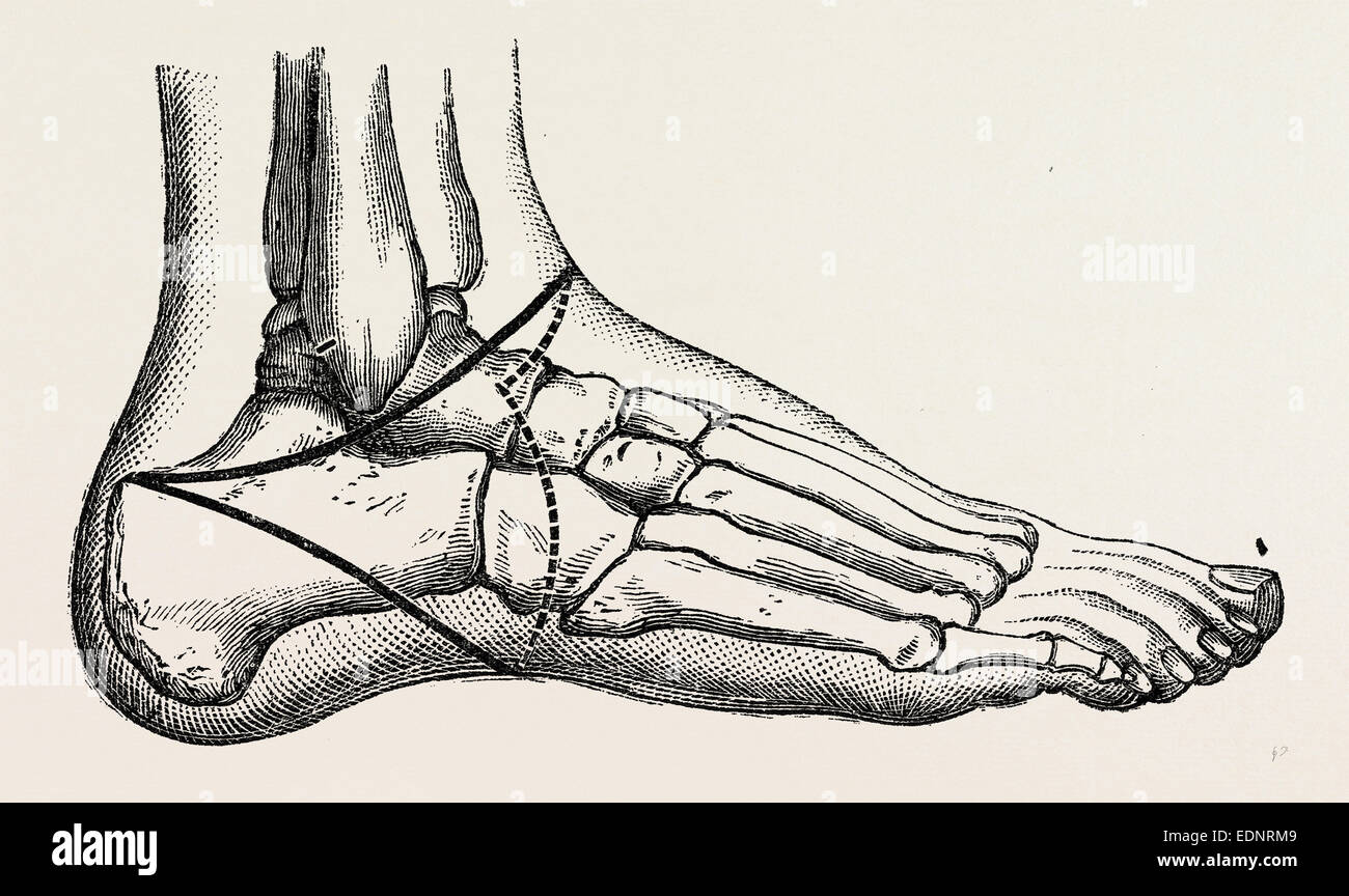 roux's amputation, medical equipment, surgical instrument, history of ...