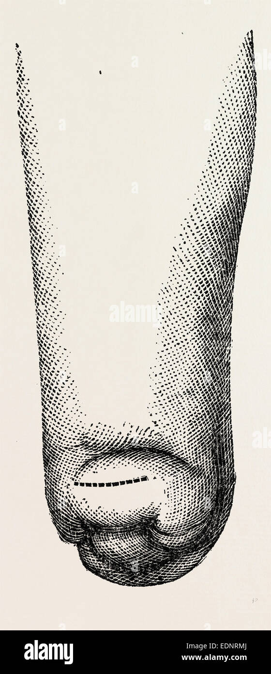 stump, medical equipment, surgical instrument, history of medicine