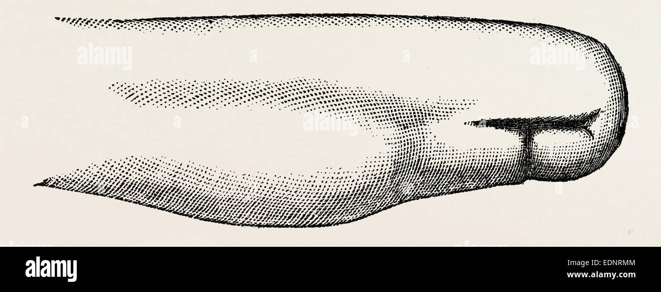 stump left after, medical equipment, surgical instrument, history of