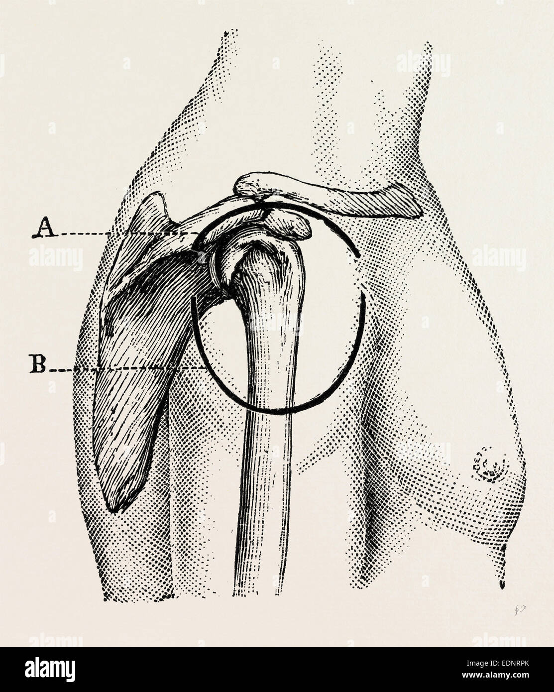 excision of the shoulder, medical equipment, surgical instrument, history of medicine Stock