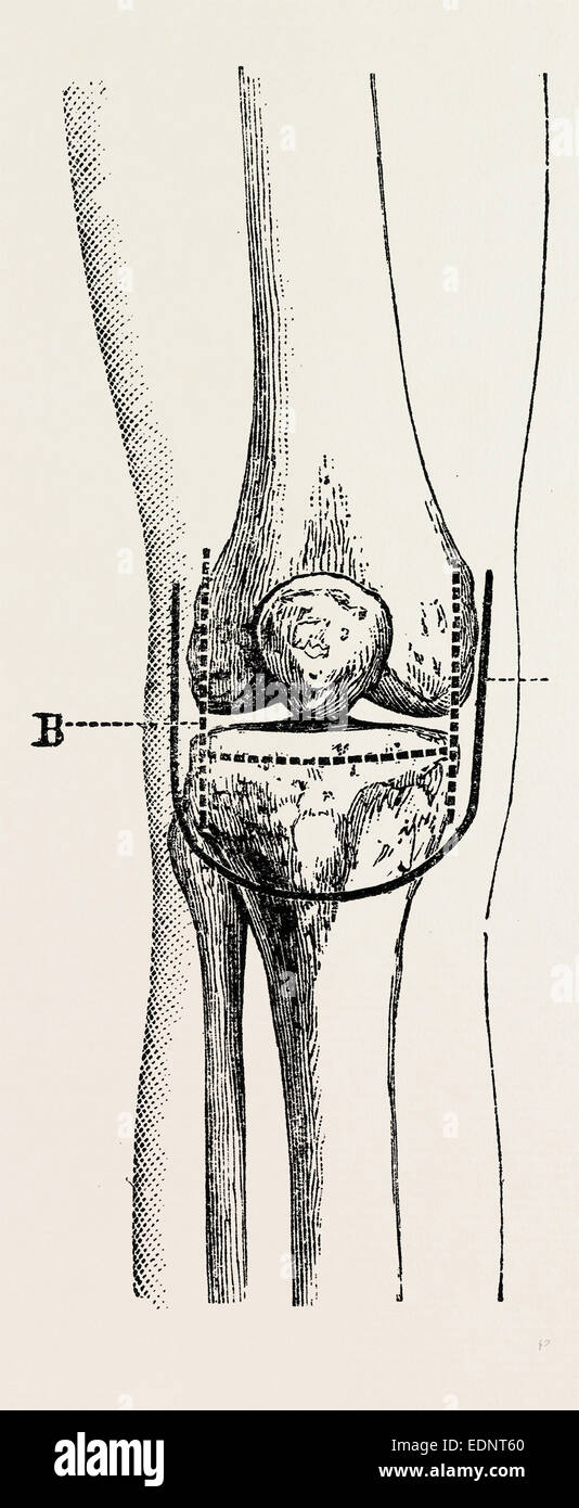 excision, medical equipment, surgical instrument, history of medicine Stock Photo Alamy