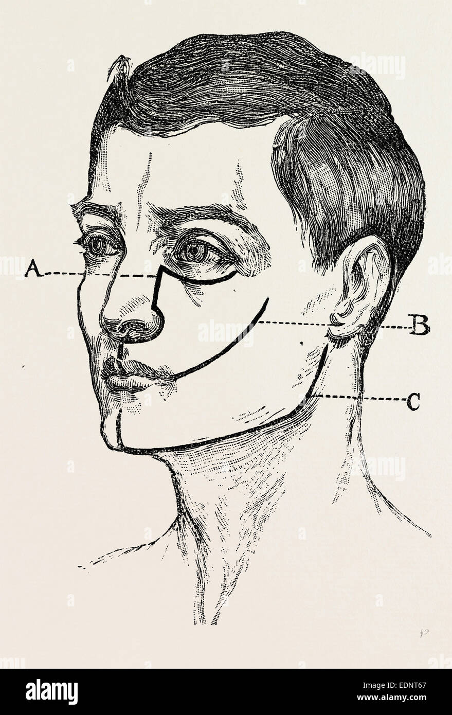 excision, medical equipment, surgical instrument, history of medicine Stock Photo Alamy