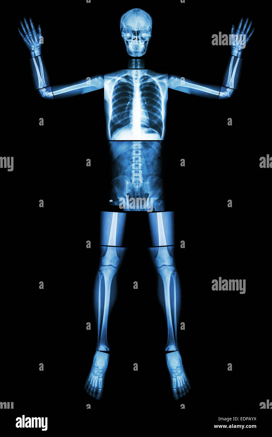 Give Up EBOLA. (Human bone raise the hand) (Whole body : head neck spine shoulder arm elbow forearm wrist hand finger thorax hea Stock Photo